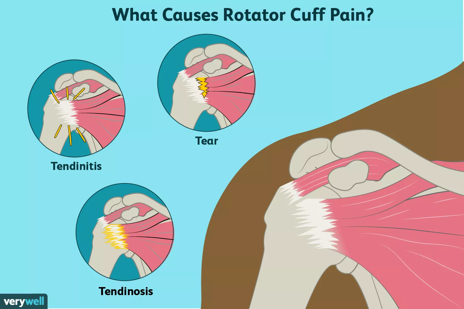 rotator cuff pain causes